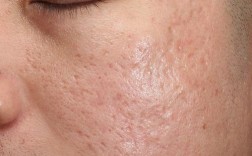 光学祛痘后还会复发吗？