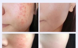 祛痘产品擦了痘痘真的会熟吗？