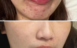 祛痘和去痘有什么区别