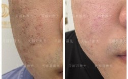 台湾激光祛痘效果到底怎么样？