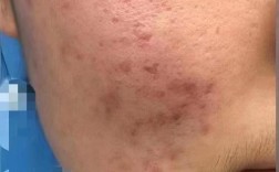 我的美丽日记祛痘效果到底如何？