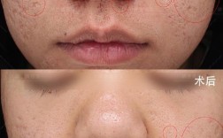 彩光祛痘印1次后效果能维持多久？