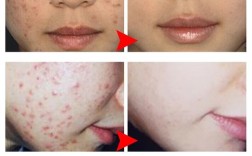 瓷肌祛痘套装正确使用步骤是？