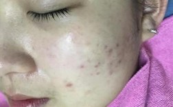 红蓝光祛痘真的有效吗？