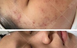 光子祛痘印后如何做好后期保养？