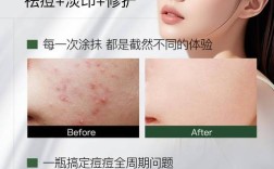 祛痘产品效果不佳怎么办？