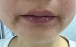 脸脱皮时能用护肤品吗？