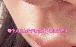 白头痘痘祛痘针真的最好用吗？