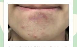 下巴长痘用祛痘老偏方有效吗？