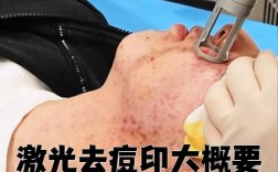 激光祛痘印常用哪些激光类型？