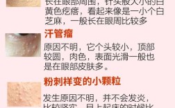 护肤品用着就长脂肪粒怎么办？