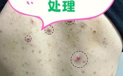 Lush脸部背部祛痘效果如何？