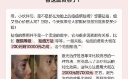 正规医院激光祛痘一般多少钱？