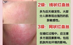 祛红血丝和祛痘坑，先处理哪个更有效？