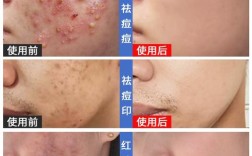 狮王祛痘能治哪种痘痘？