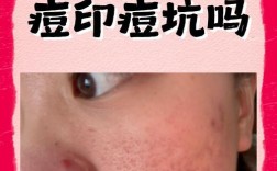 光子嫩肤祛痘印会复发吗？