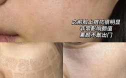 激光祛痘多久见效？