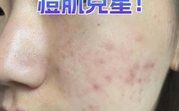 中药面膜能祛痘坑吗？