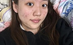 祛痘原液用后脸痒怎么回事？