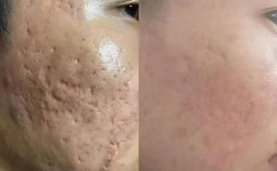 痘印修复和祛痘，到底有啥区别？