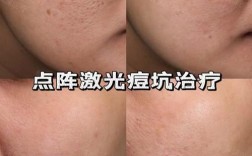 激光祛痘坑后即刻效果如何？