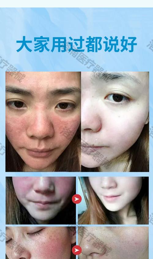 什么护肤品适合温和舒缓脸部过敏肌肤？-图2