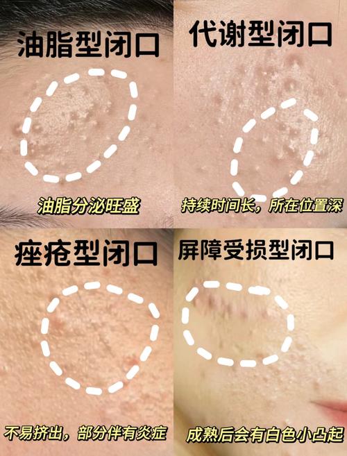 ITS SKIN祛痘效果真的好吗？-图3