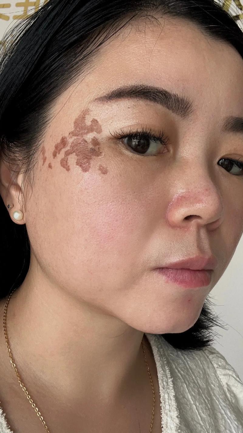 SNP龙祛痘祛斑抗敏绿效果到底如何？-图2