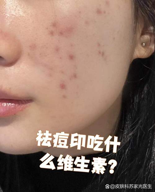 维C涂痘印真能祛痘印吗？-图3