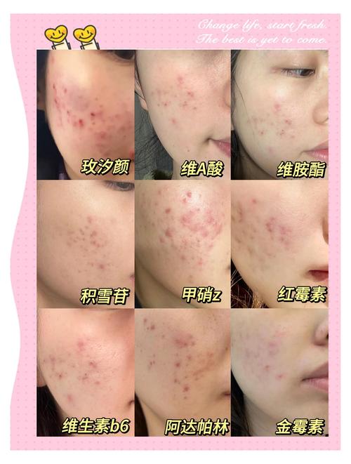 维C涂痘印真能祛痘印吗？-图1