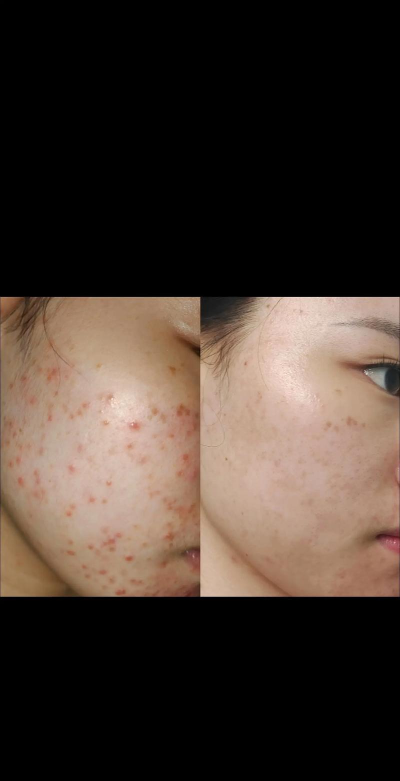 aloederma祛痘效果真的好吗？-图2