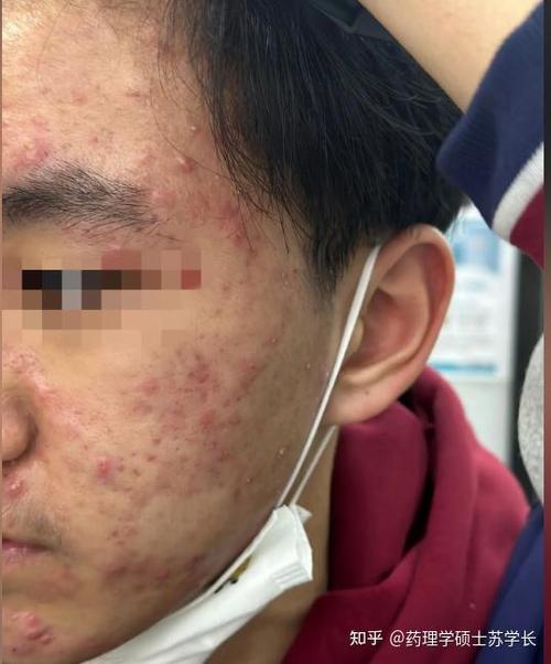 proactive祛痘30天真的有效吗？-图2