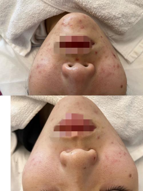 nakeup face祛痘印真的有效吗？-图1