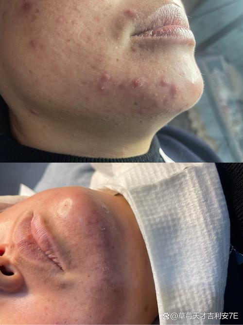 nakeup face祛痘印真的有效吗？-图2