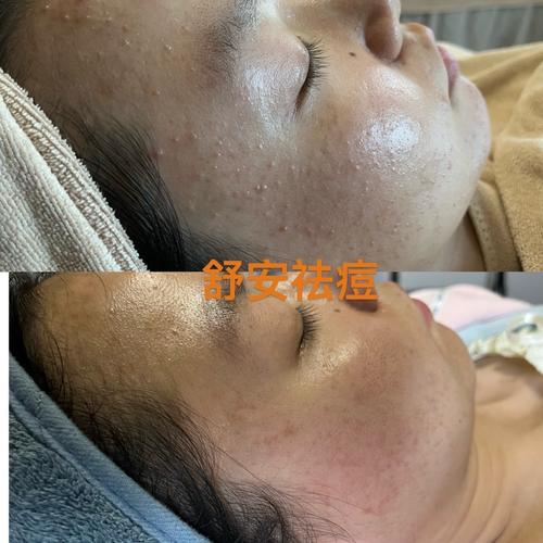 Vidivici祛痘效果真的好吗？-图3