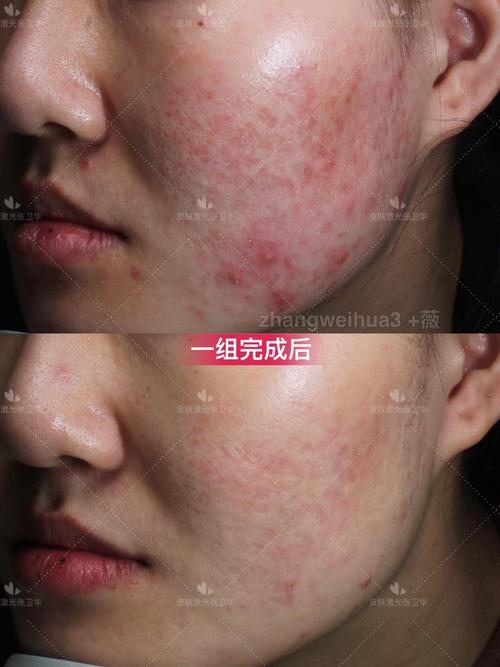 Vidivici祛痘效果真的好吗？-图1