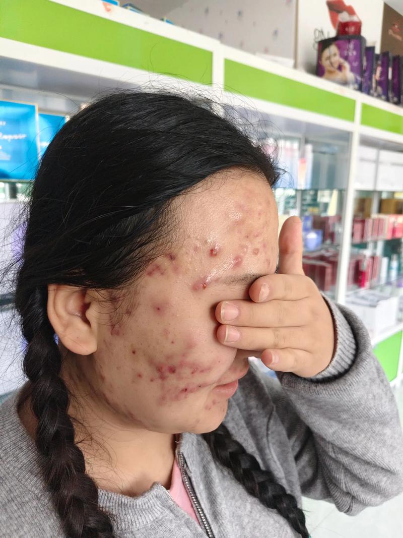 Clarisonic祛痘效果真的好吗？-图1