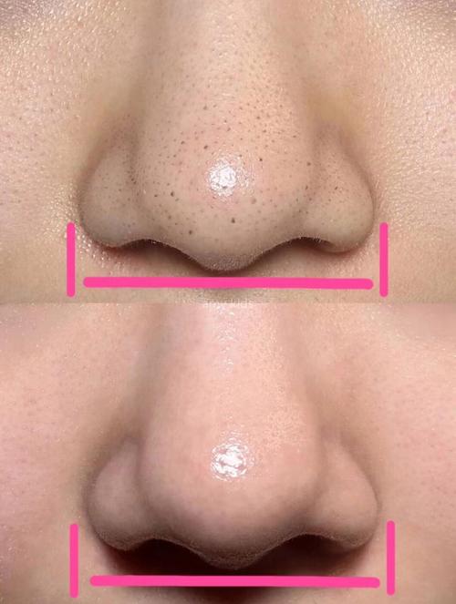 dermalogica 祛痘-图1