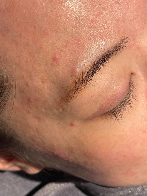 祛痘后还需继续洗脸吗？-图3