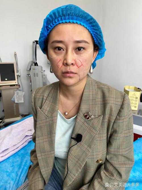 tanda zap蓝光祛痘真的有效吗？-图2