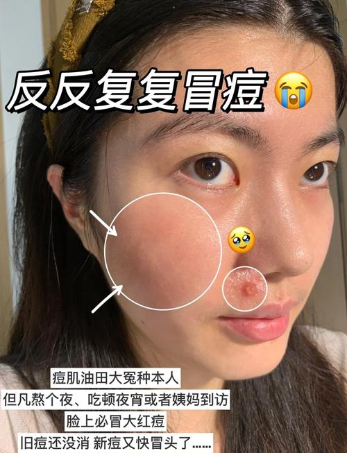 泰国anti acne祛痘真的有效吗？-图1