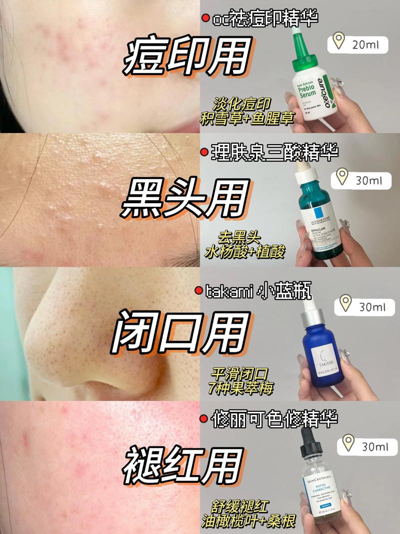 covermark祛痘图片真实效果到底怎么样？-图2