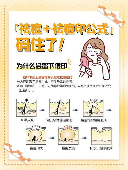 祛痘祛痘印最有效方法是什么？-图1