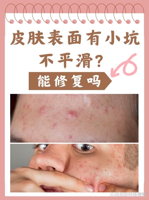 光学祛痘后还会复发吗？-图3