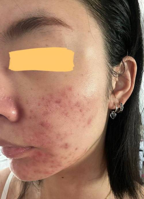 白醋祛痘方法是什么？-图1