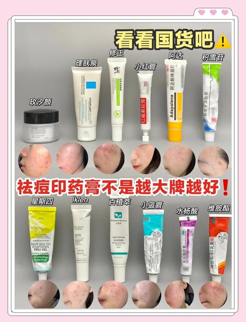 中州药膏祛痘效果是真的吗?-图2 中州药膏祛痘效果是真的吗?-图2