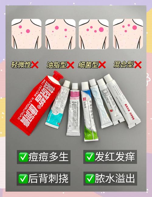 红霉素软膏能治背部痘痘吗?-图3 红霉素软膏能治背部痘痘吗?-图3
