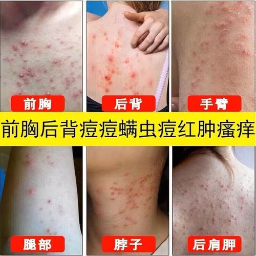 红霉素软膏能治背部痘痘吗?-图1 红霉素软膏能治背部痘痘吗?-图1