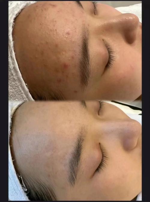 北京激光祛痘后，如何正确护理才有效？-图1