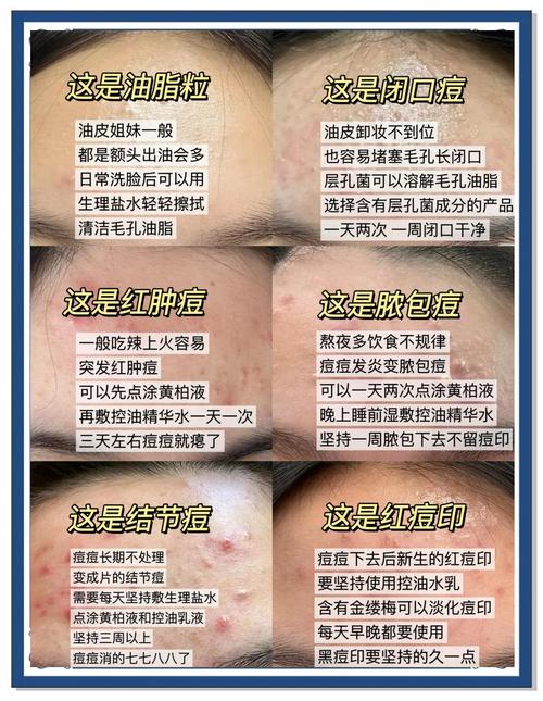 祛痘最快方法真的有效吗？-图3